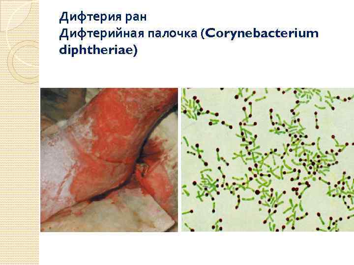 Дифтерия ран Дифтерийная палочка (Corynebacterium diphtheriae) 