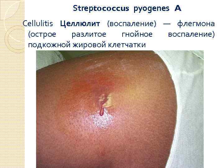 Streptococcus pyogenes A Cellulitis Целлюлит (воспаление) — флегмона (острое разлитое гнойное воспаление) подкожной жировой