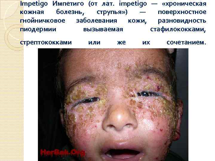 Impetigo Импетиго (от лат. impetigo — «хроническая кожная болезнь, струпья» ) — поверхностное гнойничковое
