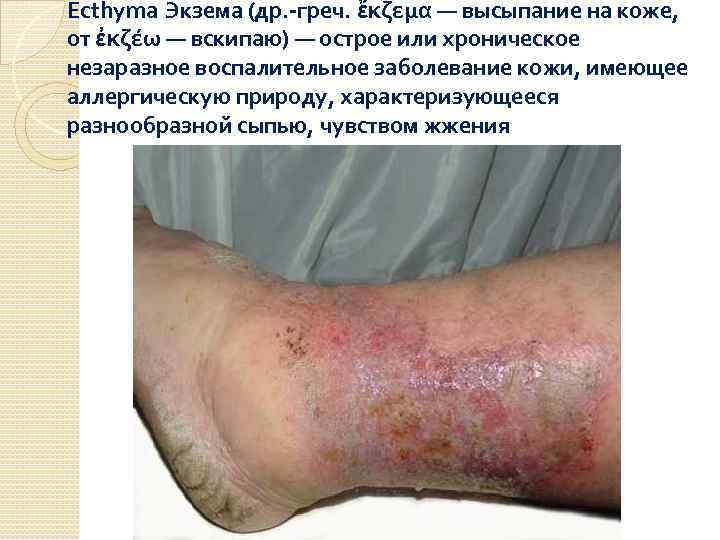 Ecthyma Экзема (др. -греч. ἔκζεμα — высыпание на коже, от ἐκζέω — вскипаю) —