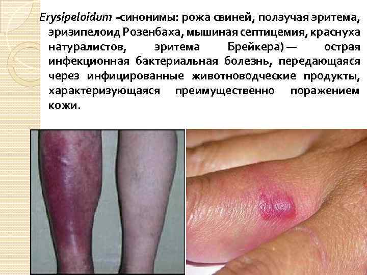 Erysipeloidum -синонимы: рожа свиней, ползучая эритема, эризипелоид Розенбаха, мышиная септицемия, краснуха натуралистов, эритема Брейкера)