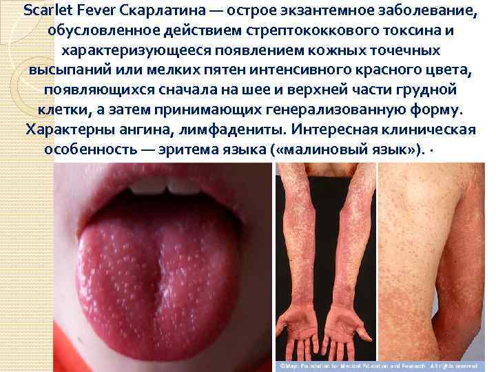 Scarlet Fever Скарлатина — острое экзантемное заболевание, обусловленное действием стрептококкового токсина и характеризующееся появлением