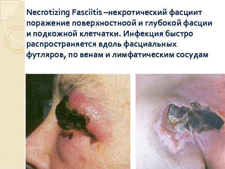 Necrotizing Fasciitis –некротический фасциит поражение поверхностноой и глубокой фасции и подкожной клетчатки. Инфекция быстро