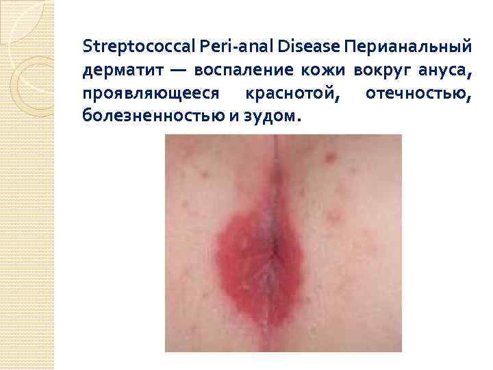Streptococcal Peri-anal Disease Перианальный дерматит — воспаление кожи вокруг ануса, проявляющееся краснотой, отечностью, болезненностью