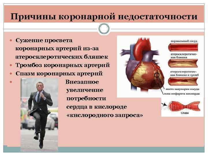 Коронарная недостаточность презентация