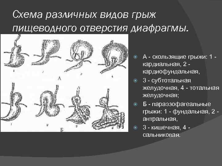 Схема различных видов грыж пищеводного отверстия диафрагмы. А - скользящие грыжи: 1 кардиальная, 2