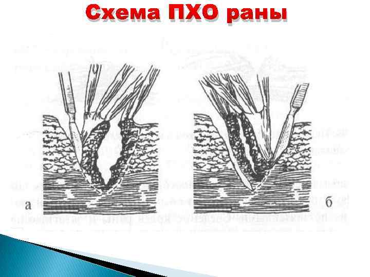 Техника хирургическая первичная обработка раны. Инструменты для Пхо раны. Вторичная хирургическая обработка раны.