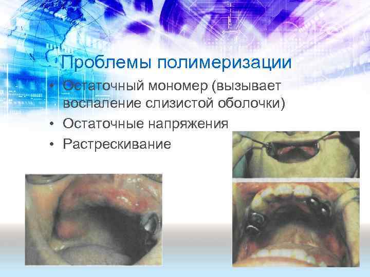 Проблемы полимеризации • Остаточный мономер (вызывает воспаление слизистой оболочки) • Остаточные напряжения • Растрескивание