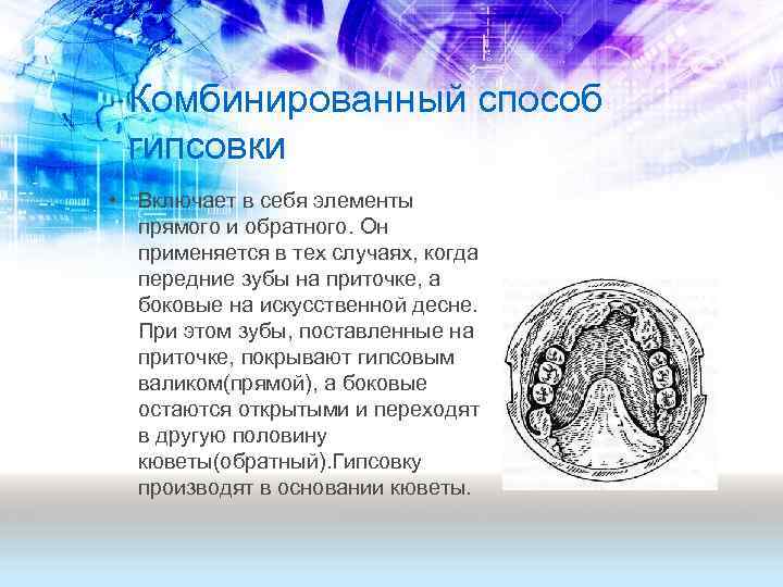 Комбинированный способ гипсовки • Включает в себя элементы прямого и обратного. Он применяется в