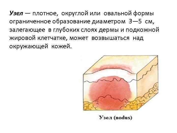 Узел — плотное, округлой или овальной формы ограниченное образование диаметром 3— 5 см, залегающее