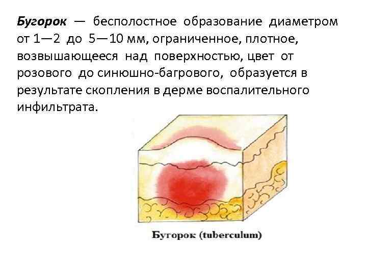 Бугорок — бесполостное образование диаметром от 1— 2 до 5— 10 мм, ограниченное, плотное,