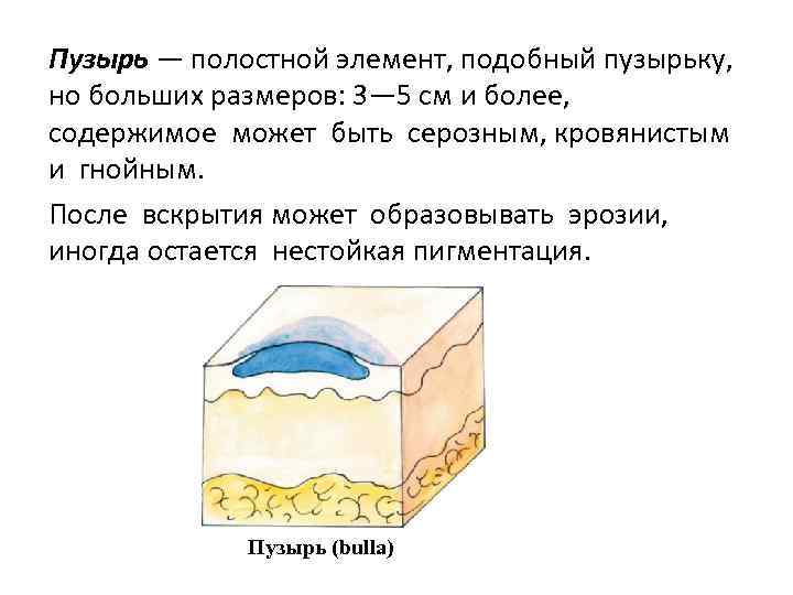 Пузырь — полостной элемент, подобный пузырьку, но больших размеров: 3— 5 см и более,