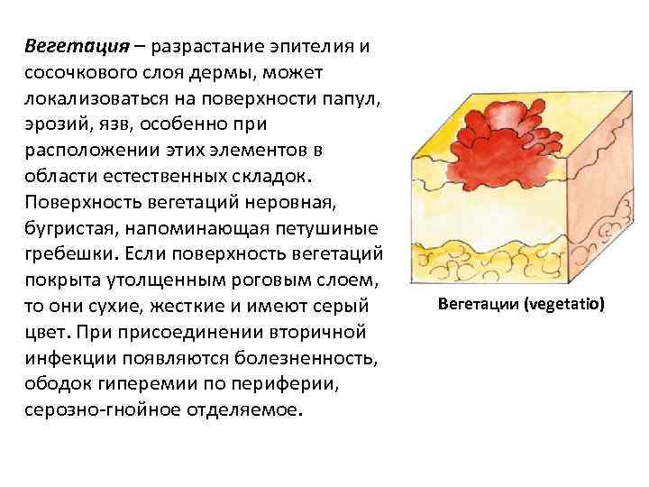 Вегетация – разрастание эпителия и сосочкового слоя дермы, может локализоваться на поверхности папул, эрозий,