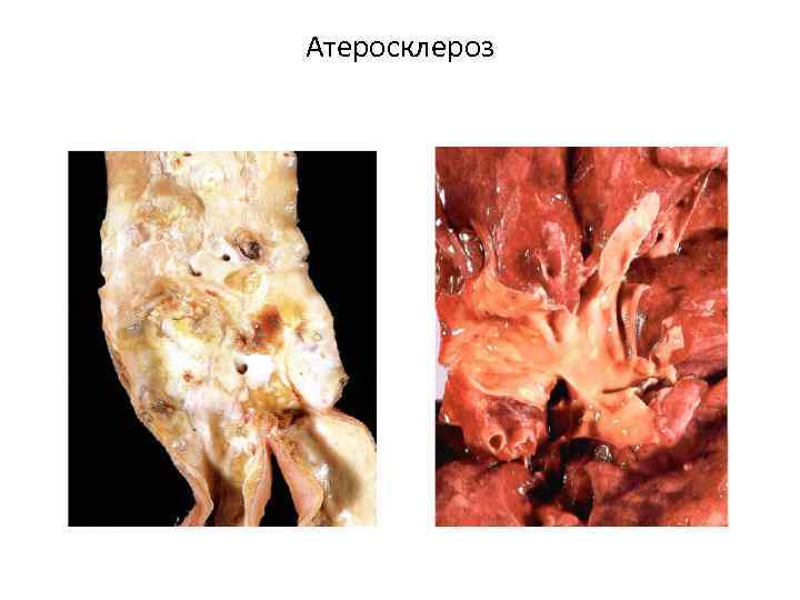 Атеросклероз 