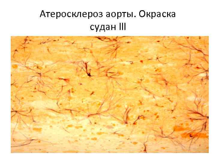 Атеросклероз аорты. Окраска судан lll 