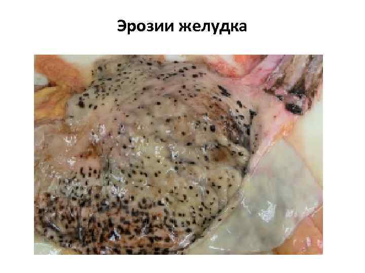 Эрозии желудка 