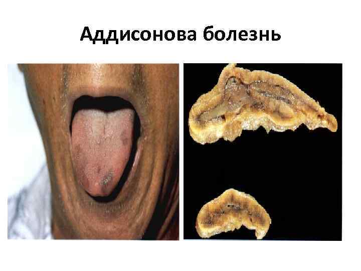 Аддисонова болезнь 