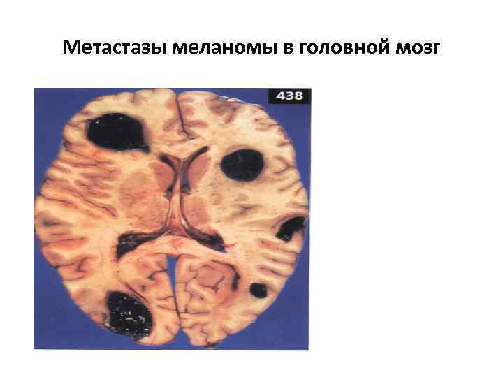 Метастазы меланомы в головной мозг 
