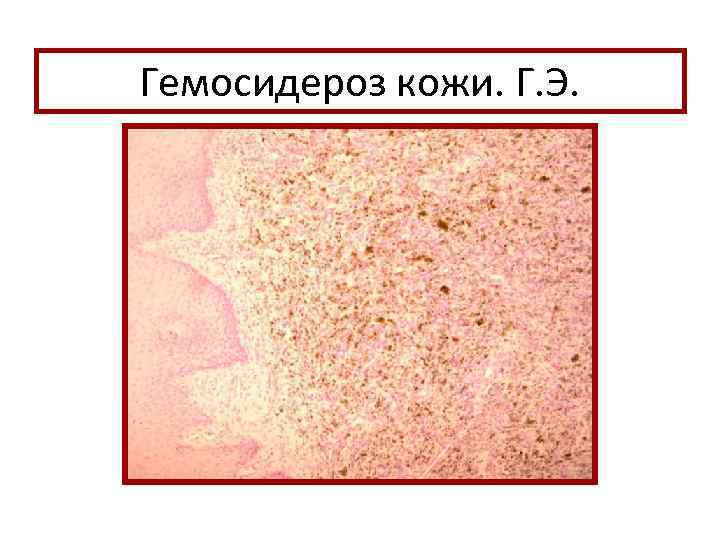 Гемосидероз кожи. Г. Э. 