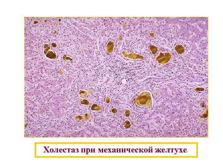 Холестаз при механической желтухе. 