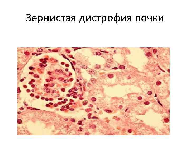 Зернистая дистрофия почки 