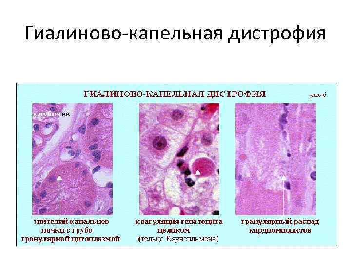 Гиалиново-капельная дистрофия 