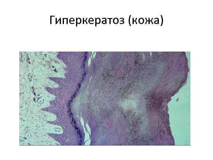 Гиперкератоз (кожа) 