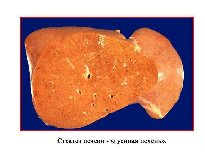 Стеатоз печени - «гусиная печень» . 