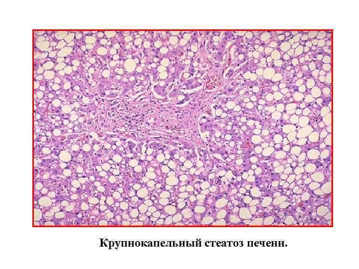 Крупнокапельный стеатоз печени. 