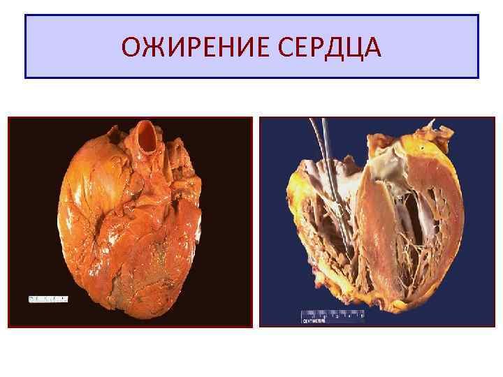 ОЖИРЕНИЕ СЕРДЦА 