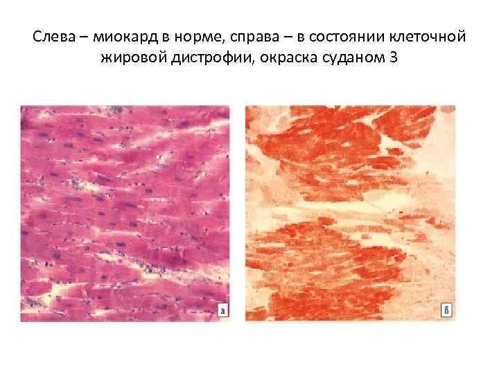 Слева – миокард в норме, справа – в состоянии клеточной жировой дистрофии, окраска суданом