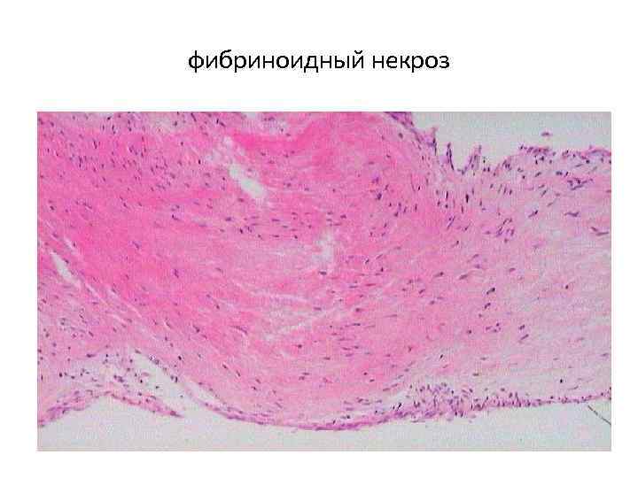 фибриноидный некроз 
