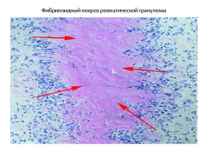 Фибриноидный некроз ревматической гранулемы 