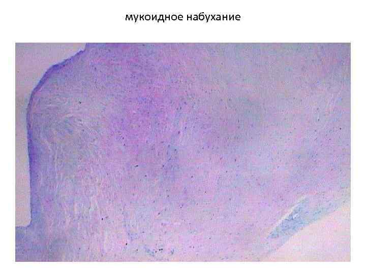 мукоидное набухание 