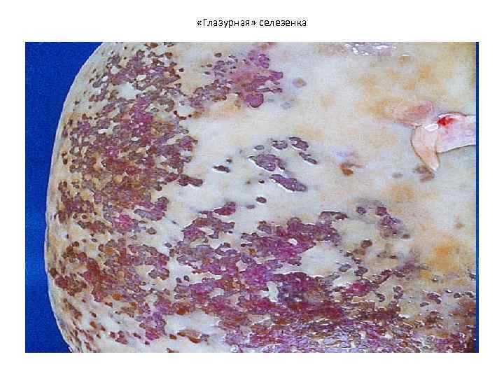  «Глазурная» селезенка 