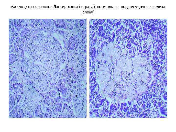 Амилоидоз островков Лангергханса (справа), нормальная поджелудочная железа (слева) 