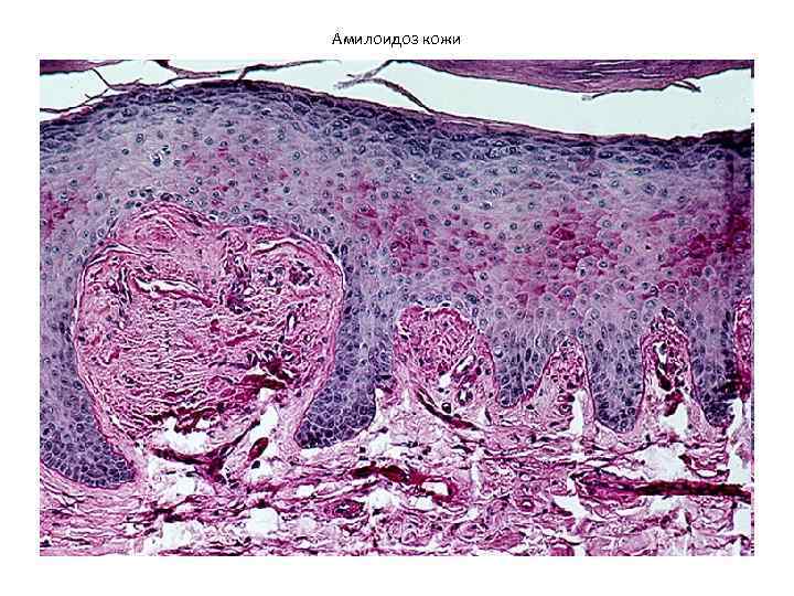 Амилоидоз кожи 