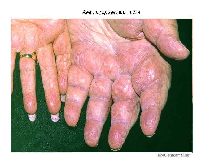 Амилоидоз мышц кисти 