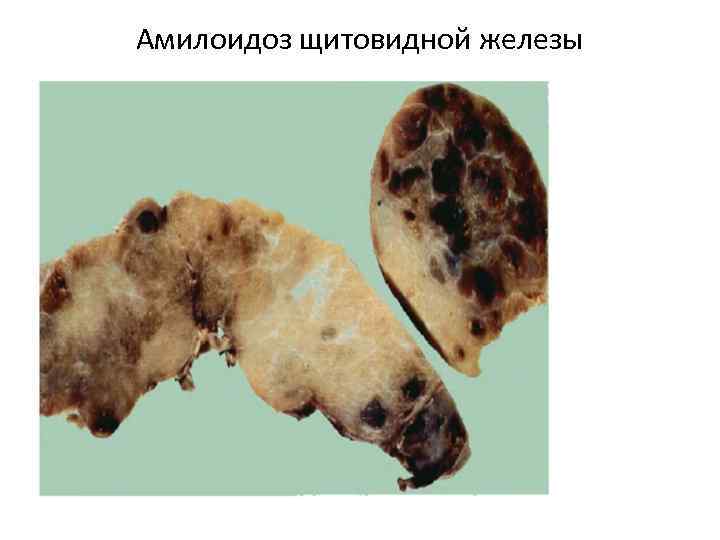 Амилоидоз щитовидной железы 