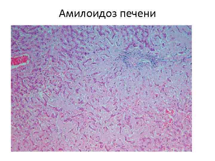 Амилоидоз печени 