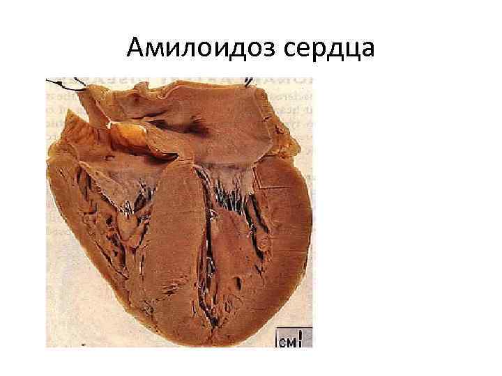 Амилоидоз сердца 