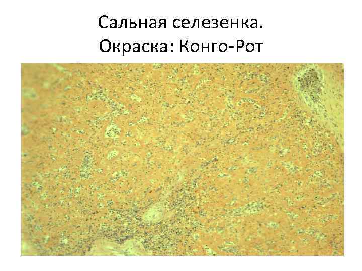 Сальная селезенка. Окраска: Конго-Рот 