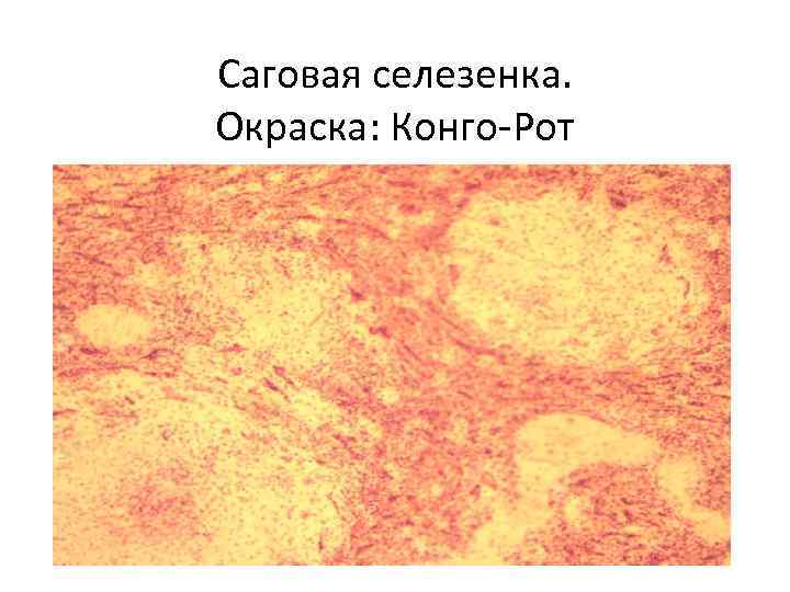 Саговая селезенка. Окраска: Конго-Рот 