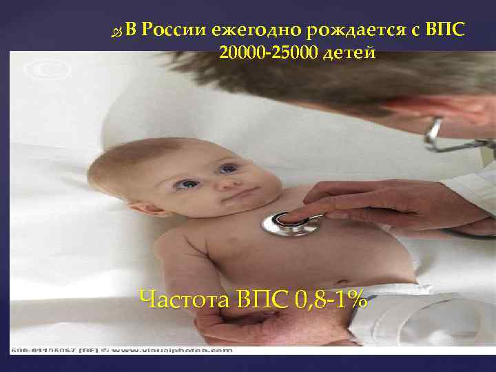  В России ежегодно рождается с ВПС 20000 -25000 детей Частота ВПС 0, 8