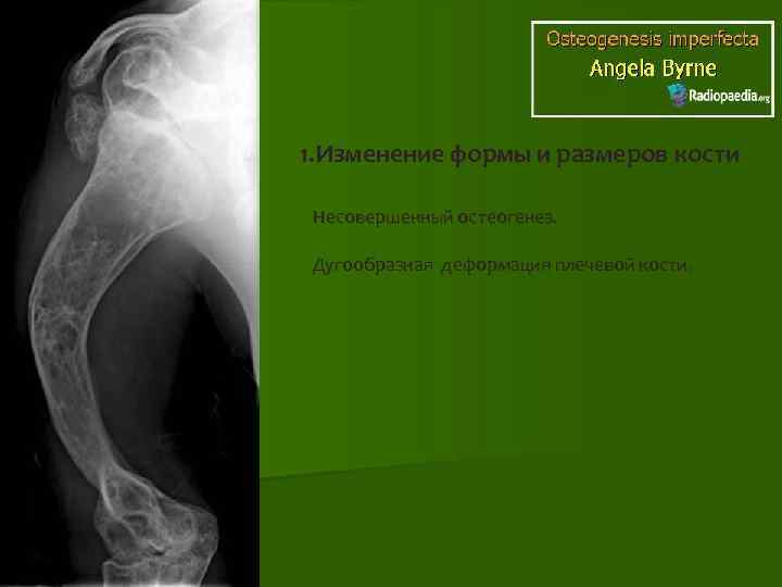 1. Изменение формы и размеров кости Несовершенный остеогенез. Дугообразная деформация плечевой кости. 
