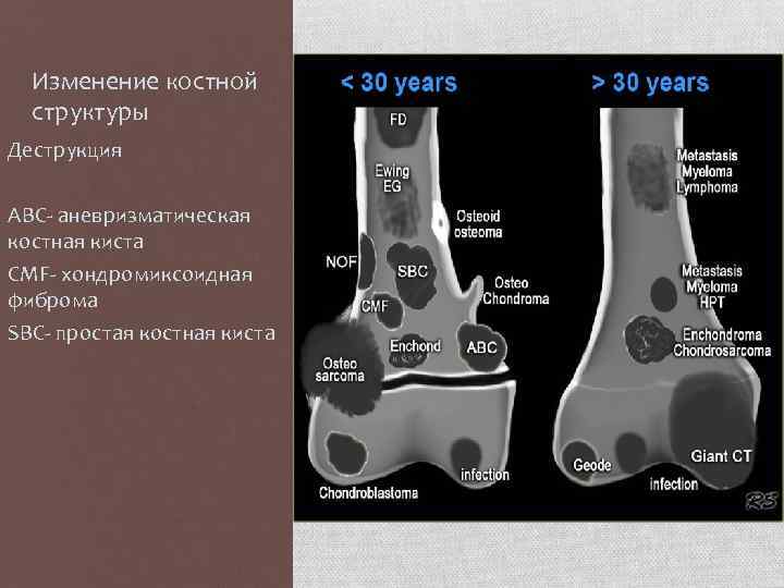Изменение костной структуры Деструкция ABC- аневризматическая костная киста CMF- хондромиксоидная фиброма SBC- простая костная