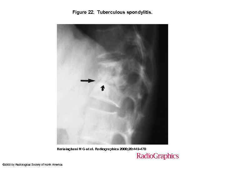 Figure 22. Tuberculous spondylitis. Harisinghani M G et al. Radiographics 2000; 20: 449 -470