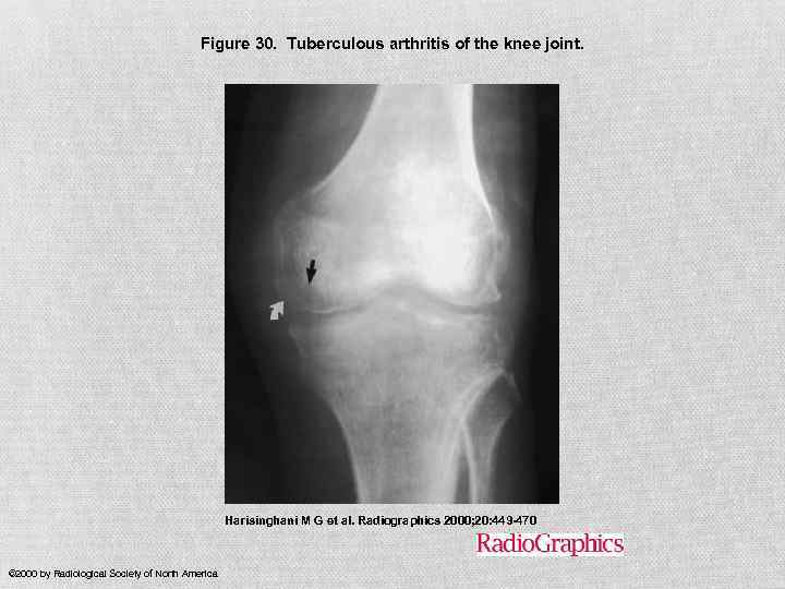 Figure 30. Tuberculous arthritis of the knee joint. Harisinghani M G et al. Radiographics