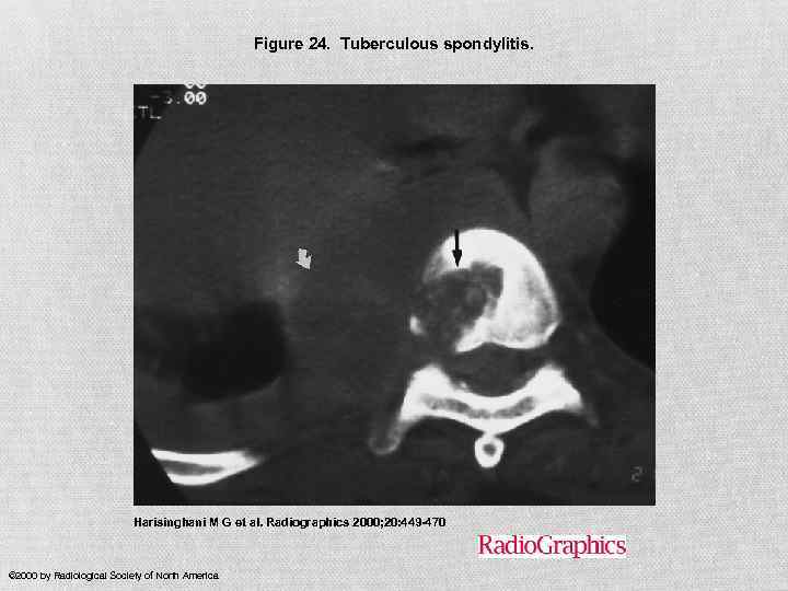 Figure 24. Tuberculous spondylitis. Harisinghani M G et al. Radiographics 2000; 20: 449 -470