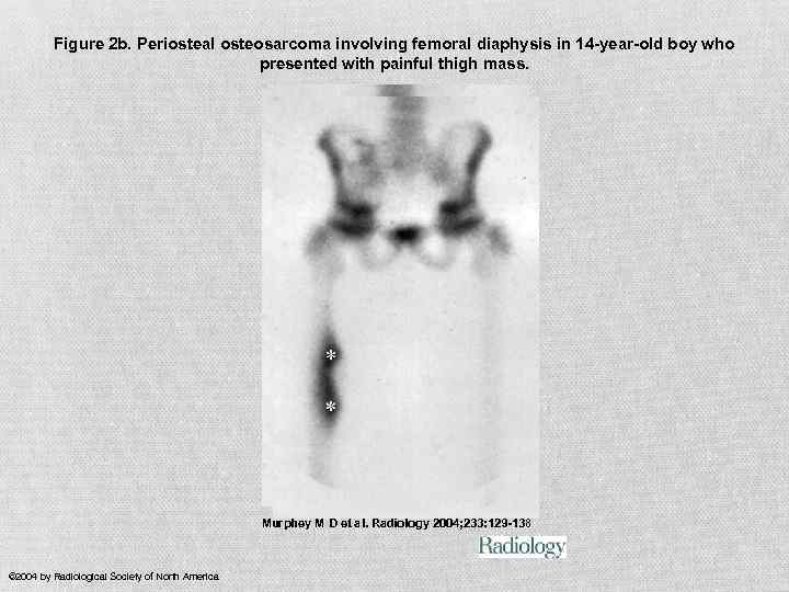 Figure 2 b. Periosteal osteosarcoma involving femoral diaphysis in 14 -year-old boy who presented